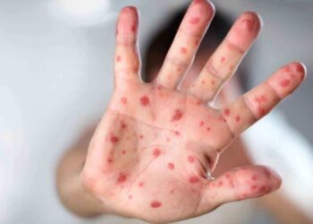 New Virus Tomato Flu detected in India, Know Symptoms & treatment