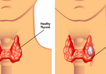 Thyroid: What are the symptoms and treatment of Thyroid?