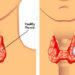 Thyroid: What are the symptoms and treatment of Thyroid?