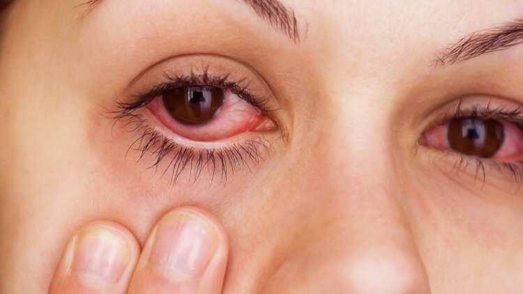 Conjunctivitis & Monsoon: Effective Tips to Prevent Pink Eyes during the Rainy Season