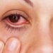 Conjunctivitis & Monsoon: Effective Tips to Prevent Pink Eyes during the Rainy Season