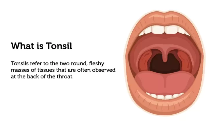 Monsoon Health Kit: Tonsils in Rainy Season; Ways To Manage It
