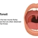 Monsoon Health Kit: Tonsils in Rainy Season; Ways To Manage It
