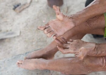 Leprosy cases rise in India; Know its causes, symptoms and treatment