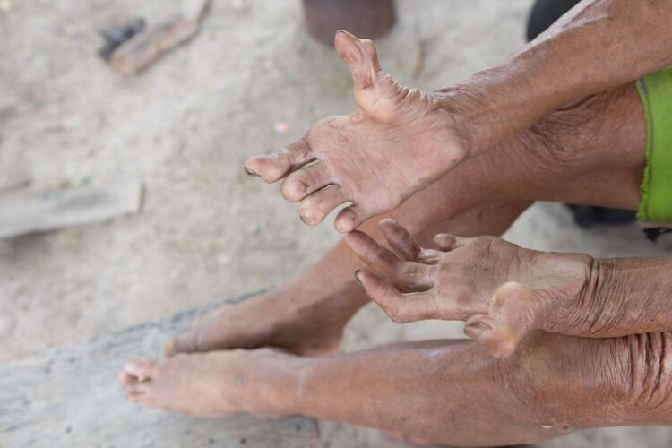 Leprosy cases rise in India; Know its causes, symptoms and treatment