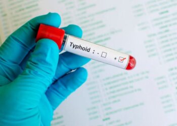 Typhoid: Know its symptoms, causes and treatment