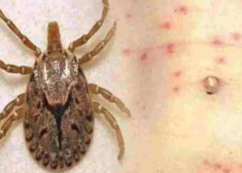 Another 10 Persons Afflicted With Scrub Typhus, Tally Increases To 193 In Odisha's Sundargarh