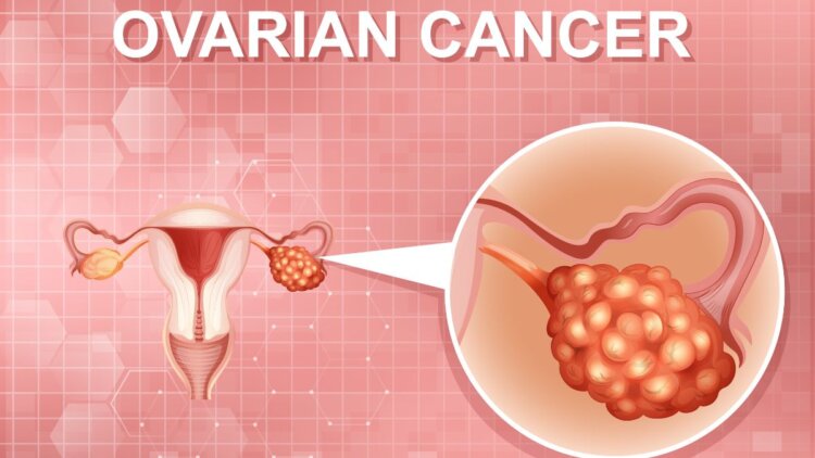 Ovarian Cancer: 6 Early Symptoms And Health Risks Women Should Never Ignore