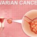 Ovarian Cancer: 6 Early Symptoms And Health Risks Women Should Never Ignore