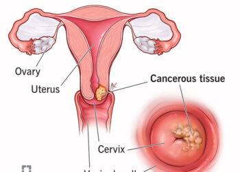 Cervical Cancer: Symptoms To Treatment, All About The Significant Health Concern In Women