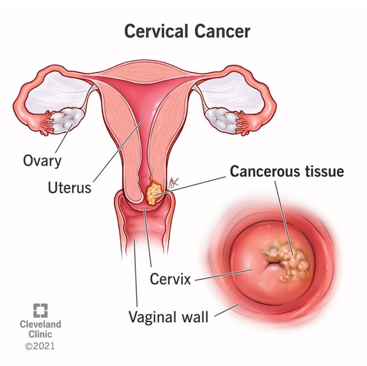 Cervical Cancer: Symptoms To Treatment, All About The Significant Health Concern In Women
