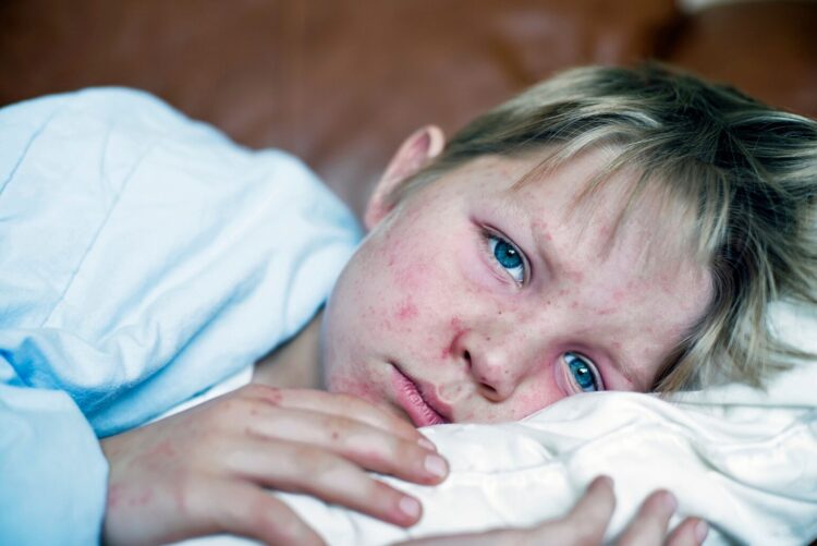 Measles Outbreak 2024: 5 Easy Home Precautions To Protect Yourself From Contagious Virus
