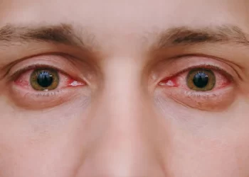 Common Eye Infections To Be Aware Of During Monsoon