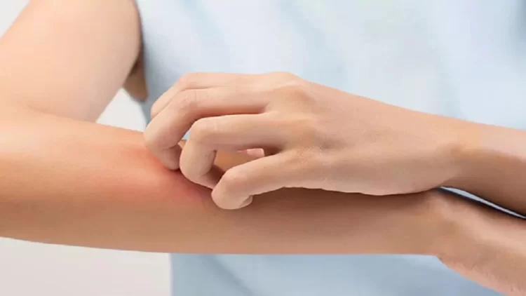 Fungal infections during monsoon: Essential tips for healthy skin and nails