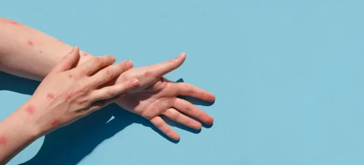 Mpox Outbreak: How Does the Virus Spread in Humans? 5 Things to Know