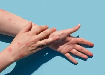 Mpox Outbreak: How Does the Virus Spread in Humans? 5 Things to Know