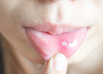 Frequent mouth ulcers? 5 potential health problems to watch out for