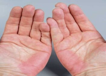 Fatty liver symptoms: 5 signs of the liver condition that show up on your hands