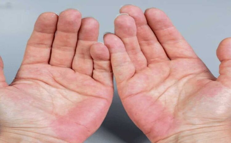 Fatty liver symptoms: 5 signs of the liver condition that show up on your hands
