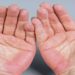 Fatty liver symptoms: 5 signs of the liver condition that show up on your hands