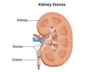Kidney stones: Causes, symptoms, treatment and complications explained by expert