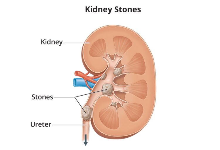 Kidney stones: Causes, symptoms, treatment and complications explained by expert