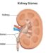 Kidney stones: Causes, symptoms, treatment and complications explained by expert
