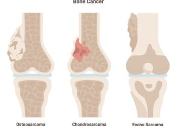 Bone Cancer: Know about the symptoms & cause