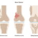 Bone Cancer: Know about the symptoms & cause
