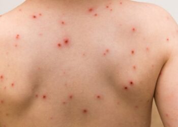 Chickenpox: Know about symptoms, causes and vaccination