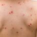 Chickenpox: Know about symptoms, causes and vaccination