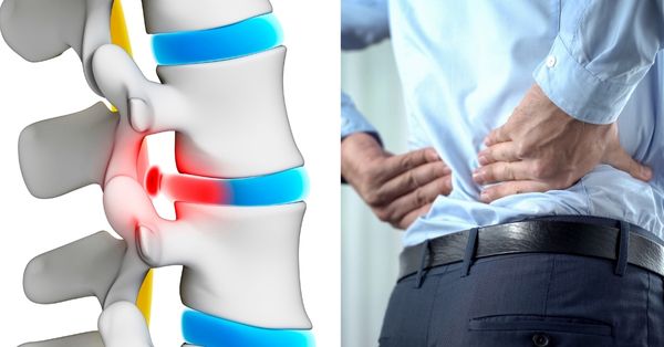 Slipped disc symptoms, causes and prevention: What working professionals should know