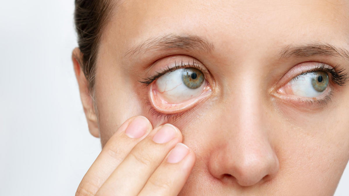 Dry eye syndrome during winter: Tips to take care of your eyes when temperature drops