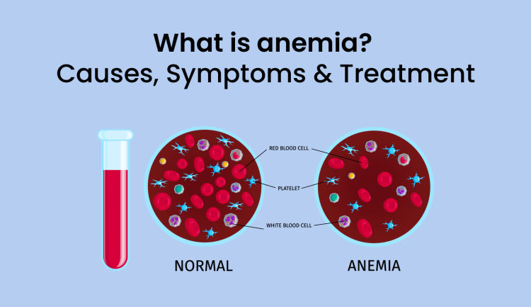 Anaemia - symptoms, causes and treatment
